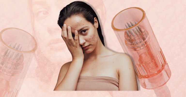 Tout savoir sur le microneedling